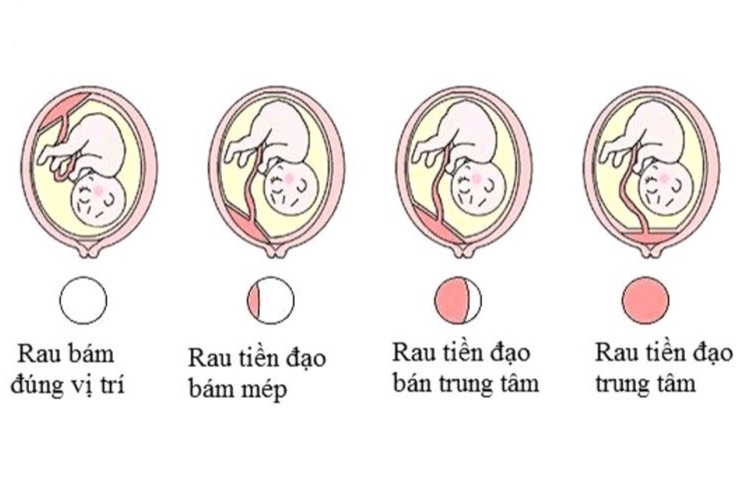 Những điều cần biết về bệnh nhau tiền đạo