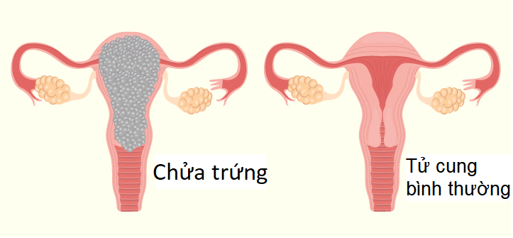 Chửa trứng: Nguyên nhân, dấu hiệu nhận biết và những hệ lụy