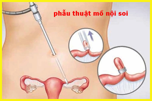 Ưu điểm phương pháp mổ nội soi u nang buồng trứng - Ưu điểm phương ...