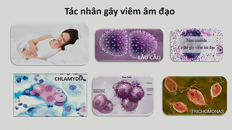 Viêm âm đạo ảnh hưởng thế nào trong quá trình mang thai? - Viêm âm đạo ảnh  hưởng thế nào trong quá trình mang thai bạn cần biết