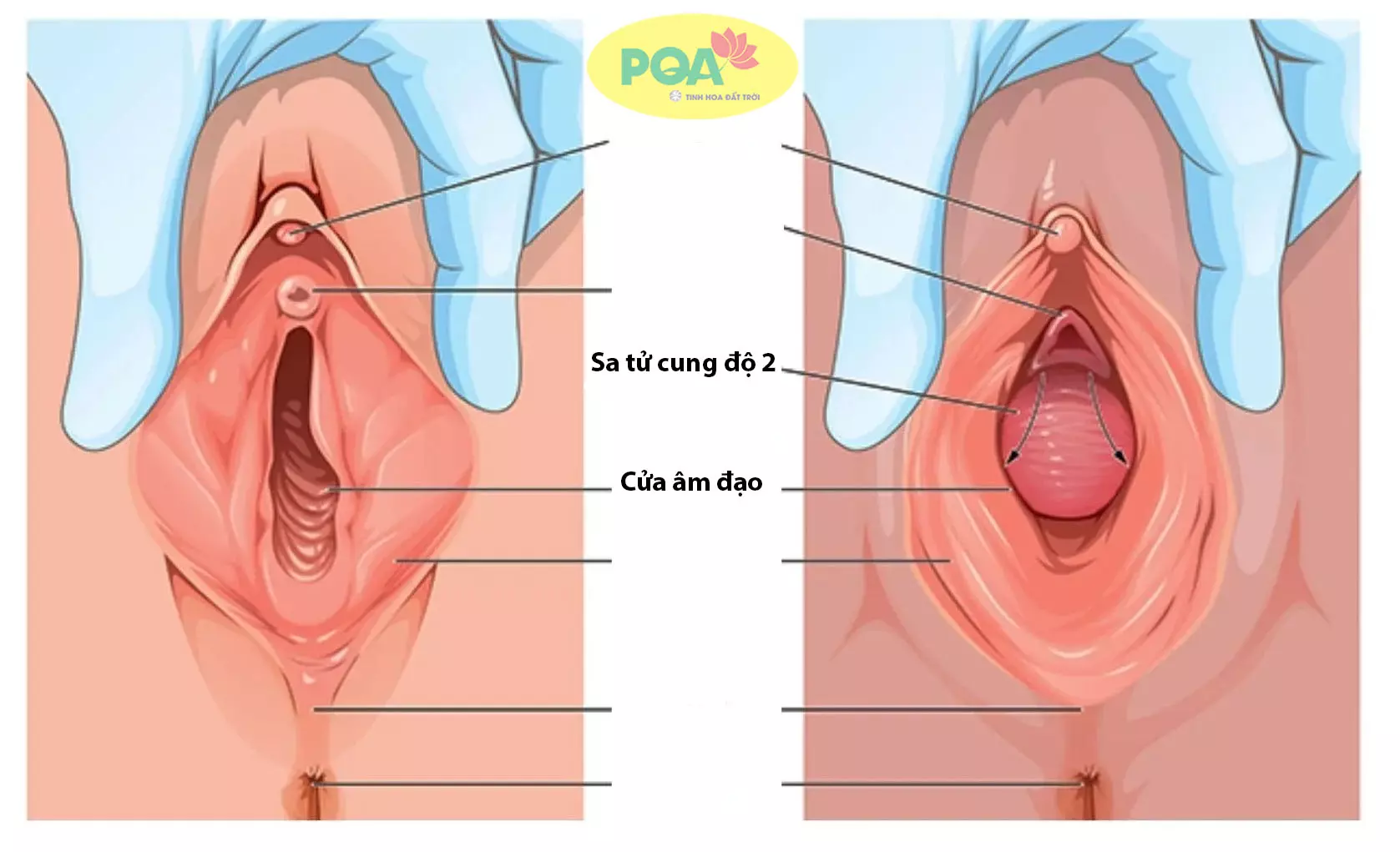 Sa Tử Cung Là Gì? Nguyên Nhân, Triệu Chứng, Và Cách Điều Trị Hiệu Quả